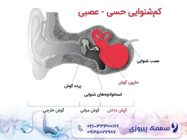کم شنوایی حسی عصبی